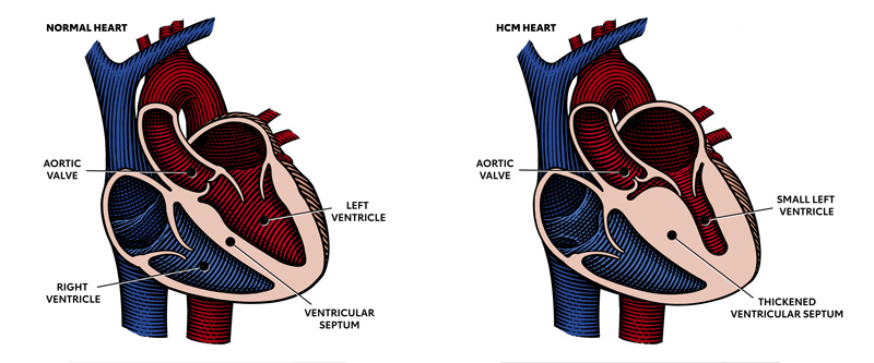 Hypertrophic Cardiomyopathy (HCM)