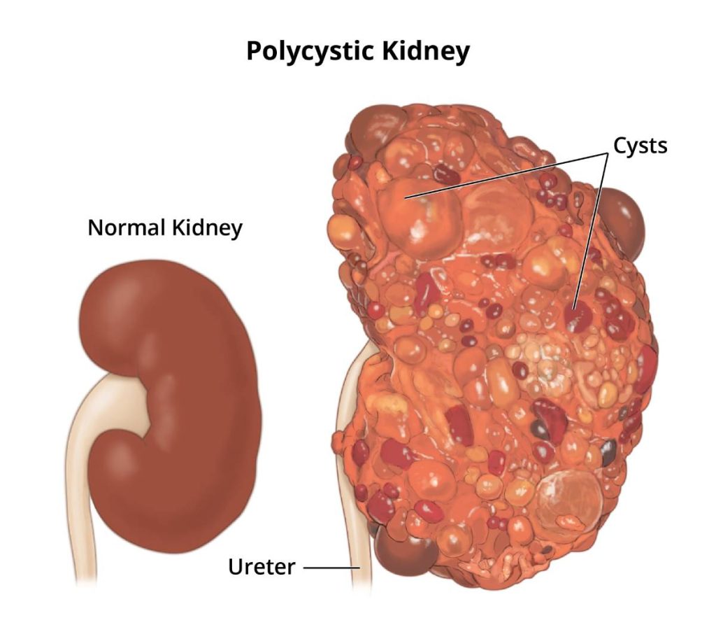 Polycystic Kidney Disease (PKD)